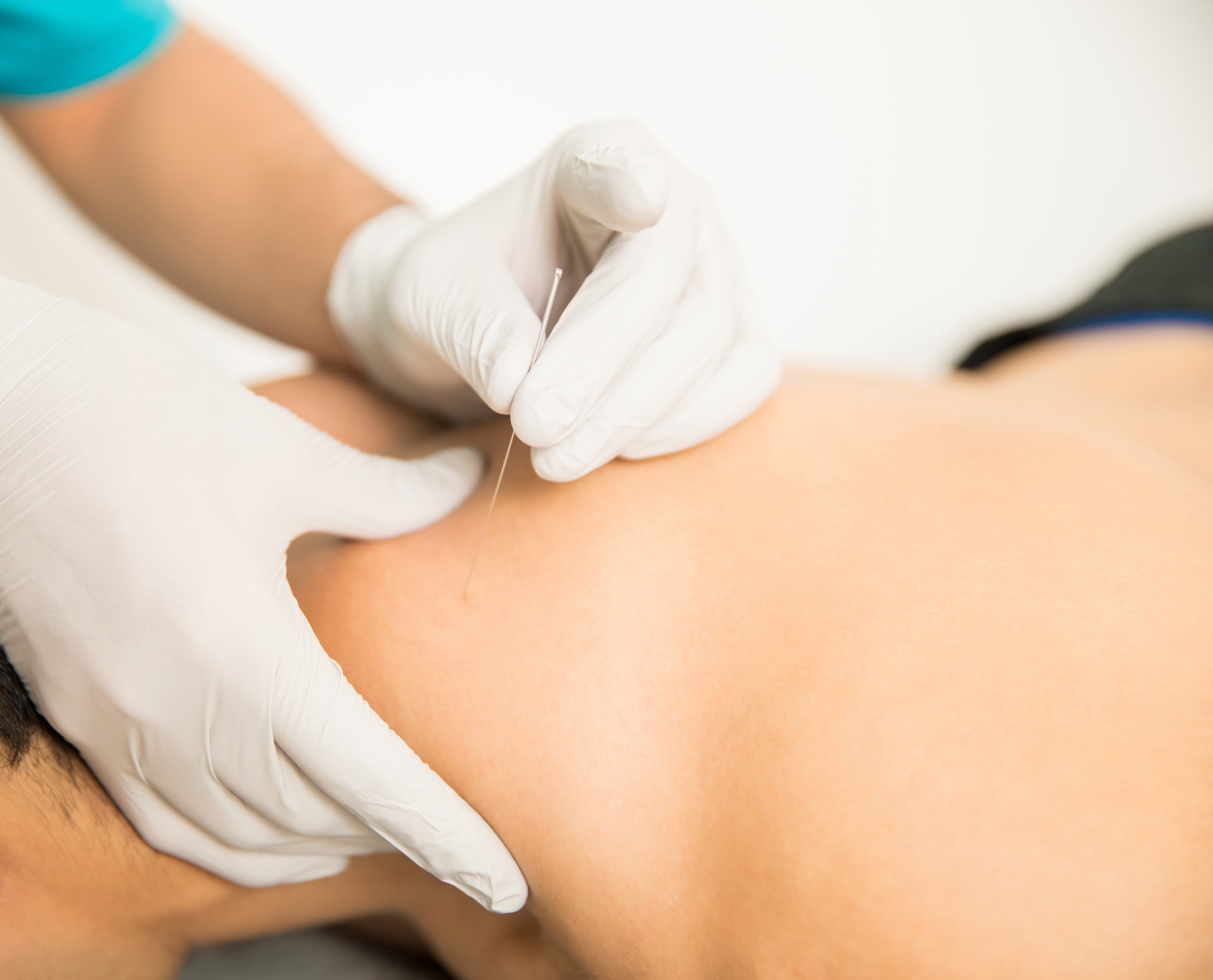 The Benefits of Dry Needling for Muscle Pain